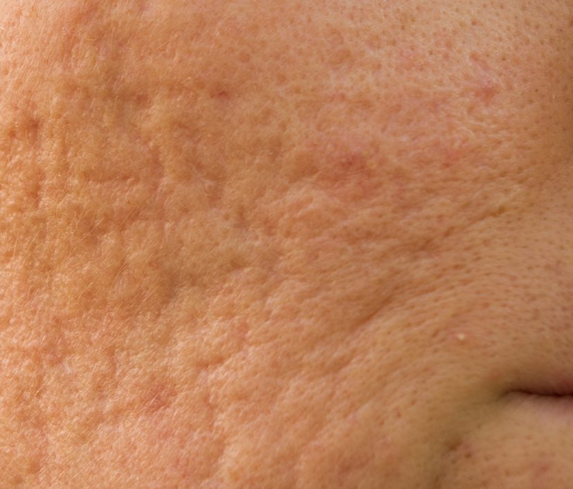 Photo of acne scars on a person's face