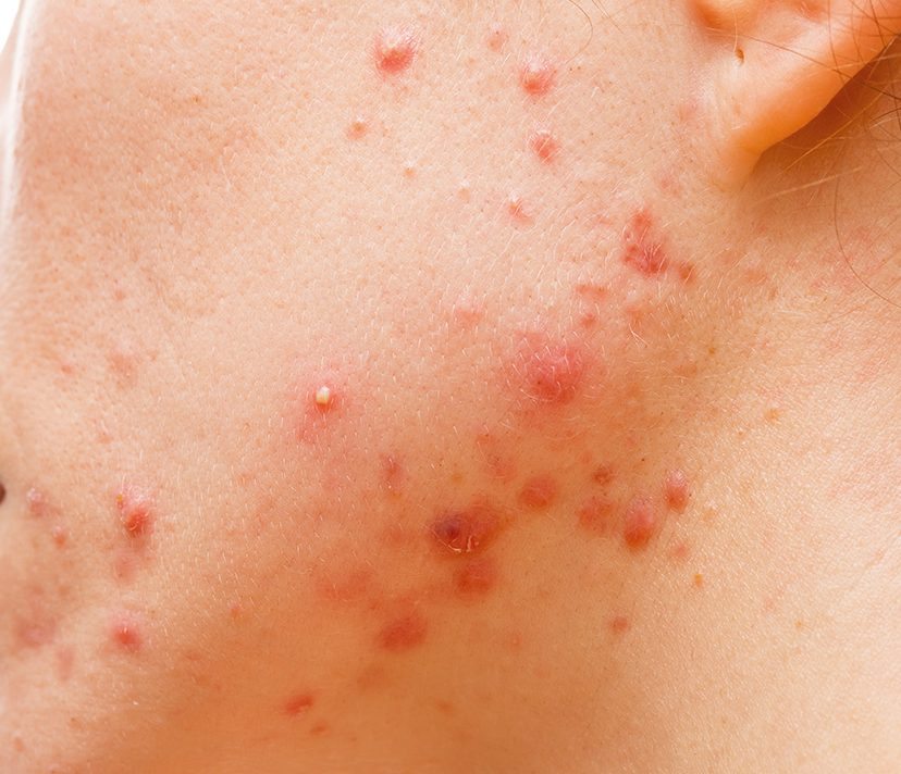 Photo of acne on a person's face