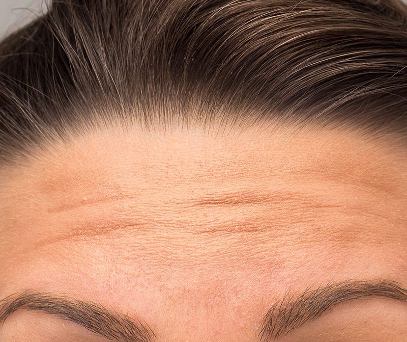 Photo of a woman's forehead lines