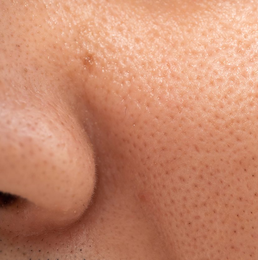 Photo of a close-up on large pores