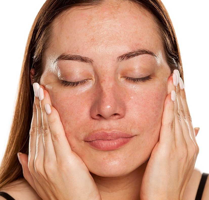 Photo of a woman with melasma on her face