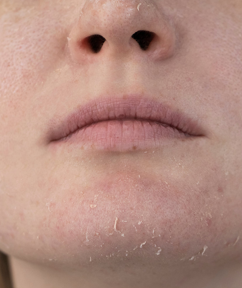 Photo of a woman with dry skin on her chin and nose