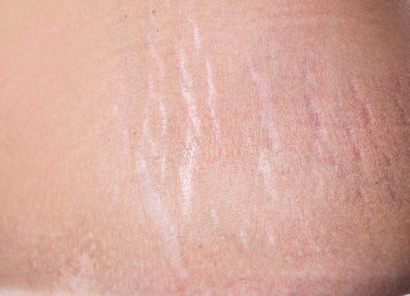 Photo of stretch marks on a person's body