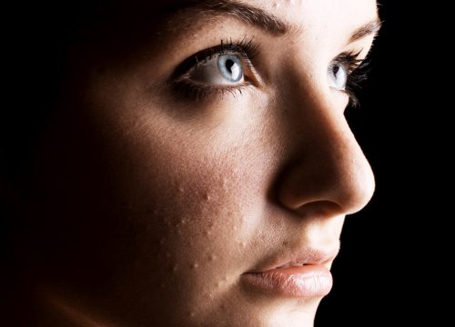 Woman with acne on her face