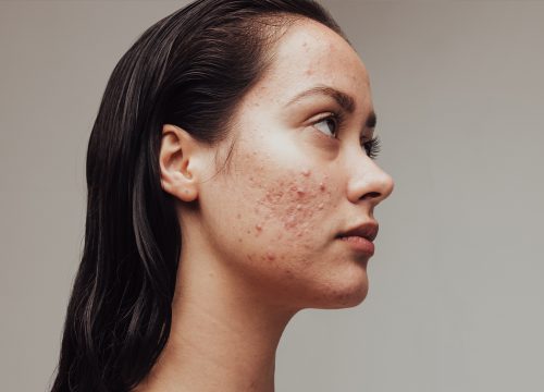 Woman with acne scars on her face