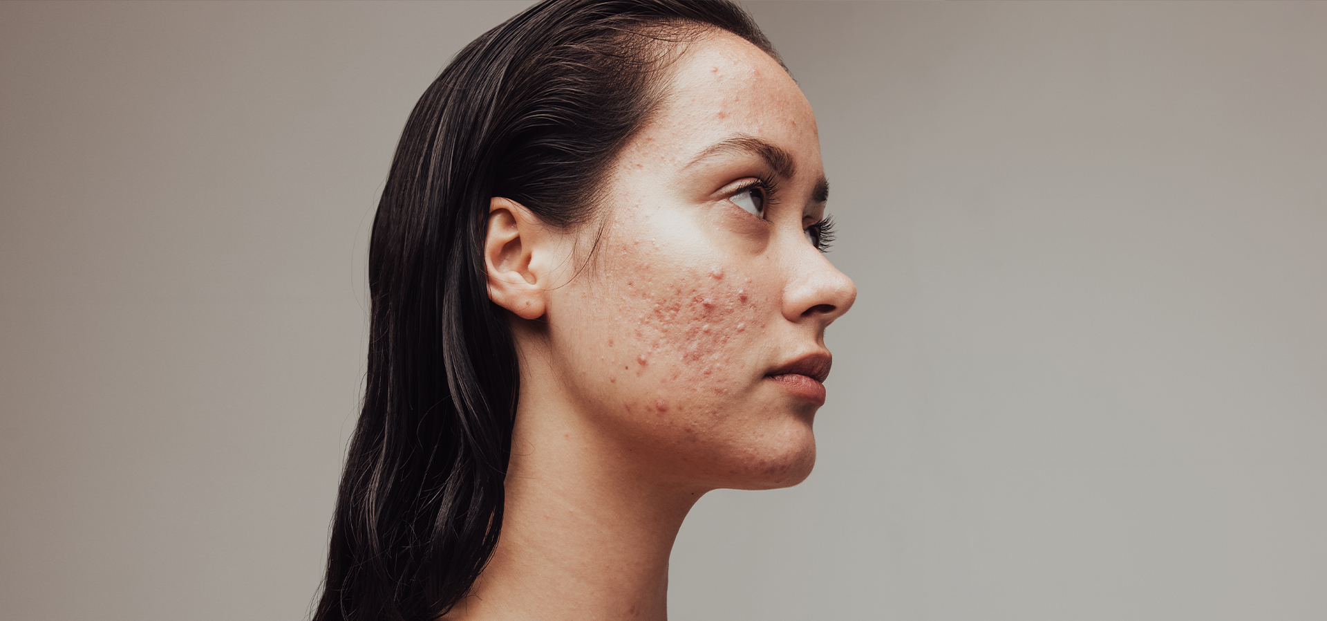 Acne Scars