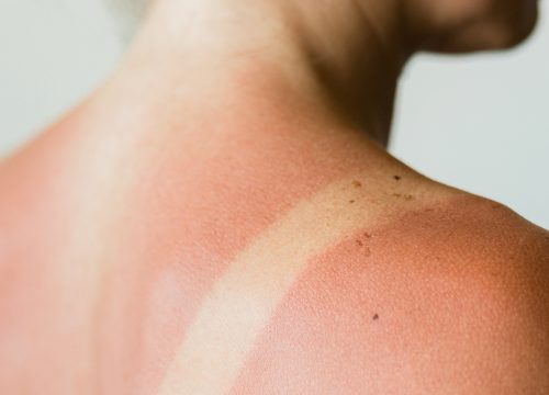 Photo of a sun burn and sun damage on a woman's shoulder