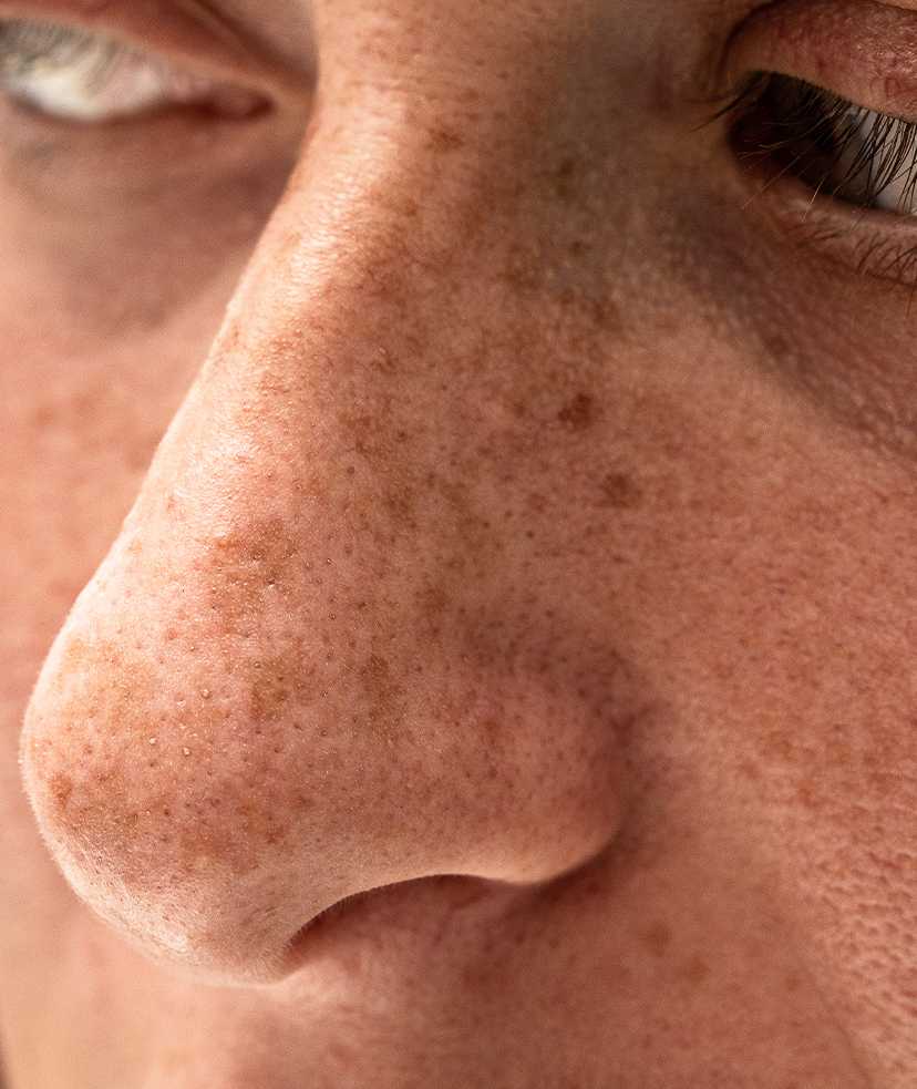 Photo of freckles on a person's nose