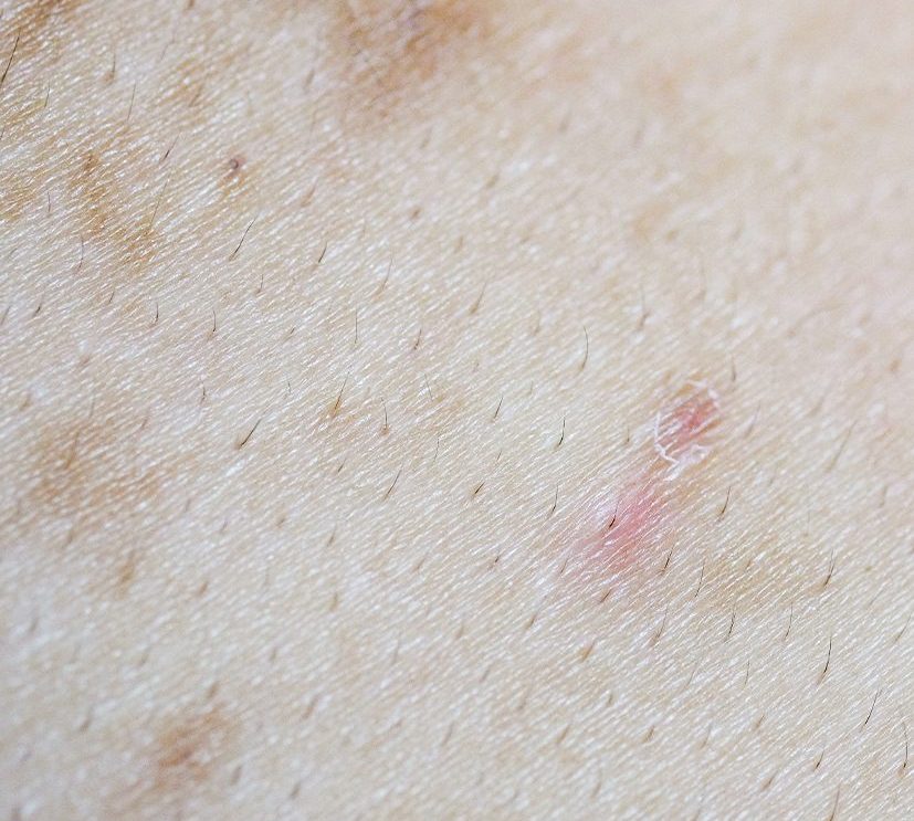 Photo of a person's uneven skin tone