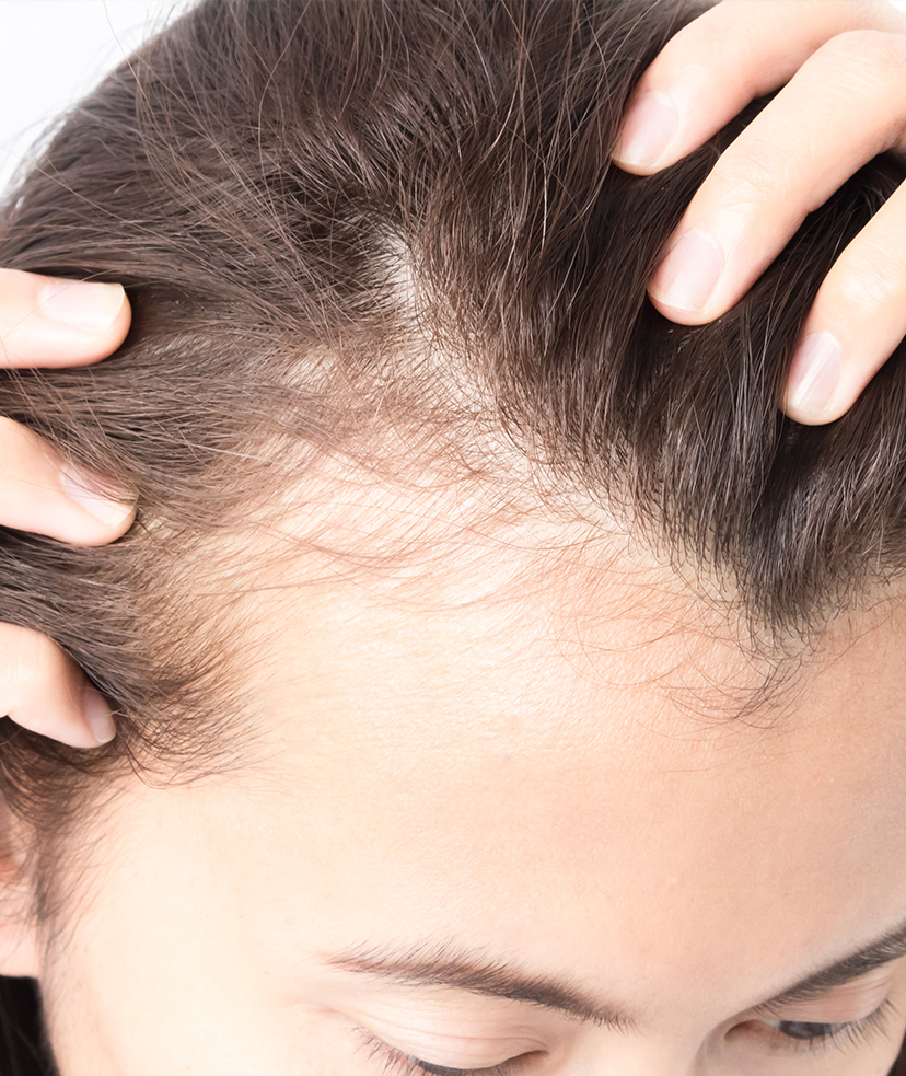 Photo of a woman experiencing hair loss