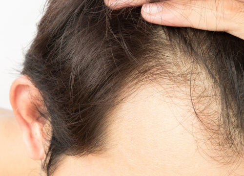 Photo of a man's receding hairline