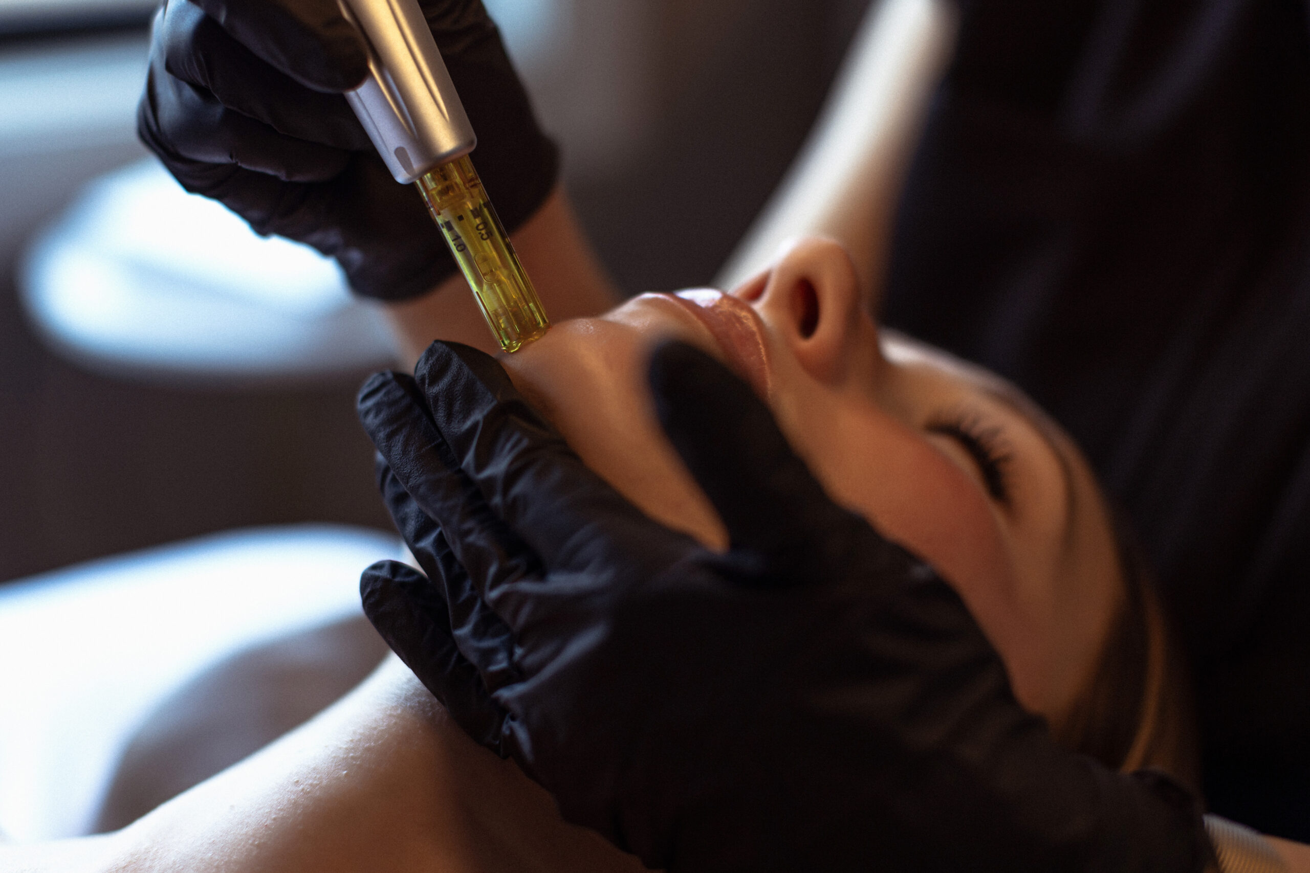 Photo of a microneedling treatment at Captivate