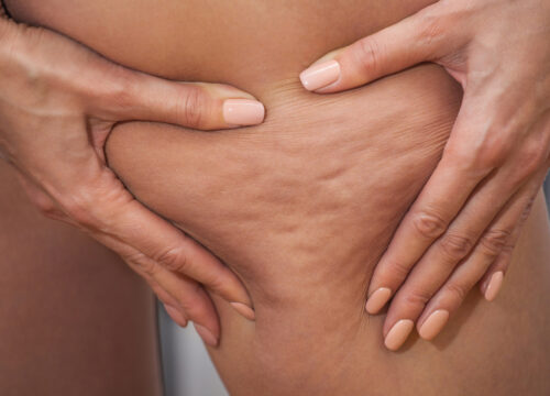 Photo of cellulite on a woman's leg